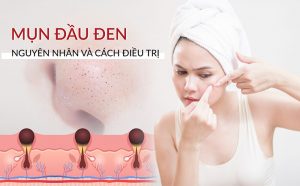 trị mụn đầu đen