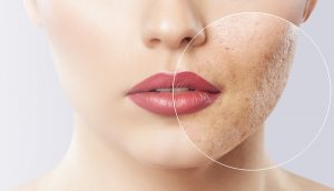 điều trị sẹo rỗ