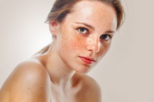 Nguyên nhân gây nên tình trạng nám da